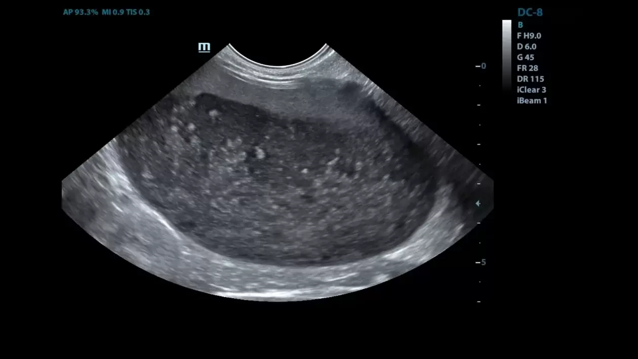 Cistite nelle mie immagini ad ultrasuoni prima di usare cistolax