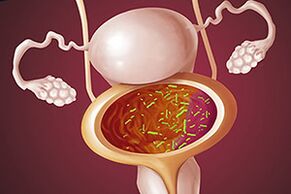 Cistite batterica in una donna